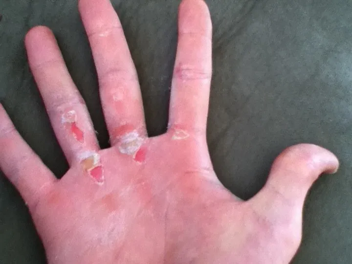 Calluses on hand